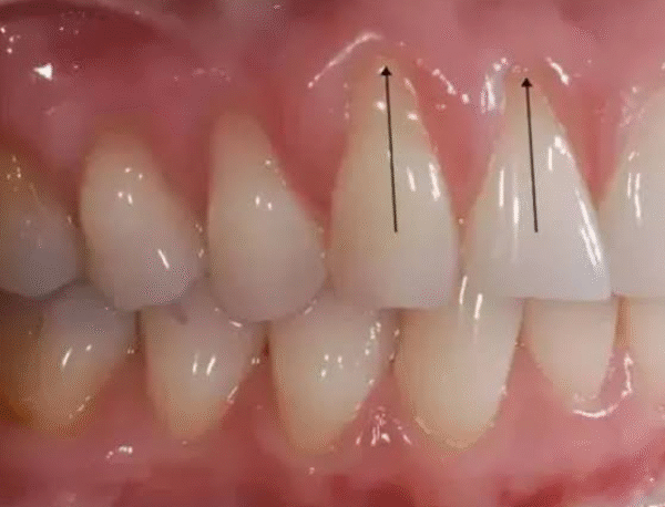 Can Tooth Colored Bonding Camouflage Small Areas Of Root Exposure?