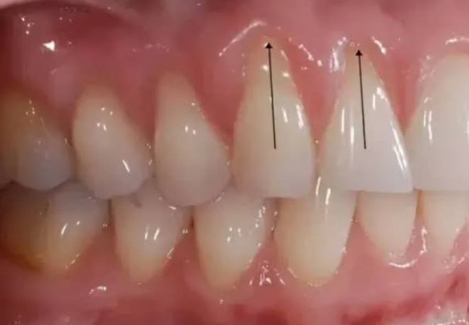 Can Tooth Colored Bonding Camouflage Small Areas Of Root Exposure?