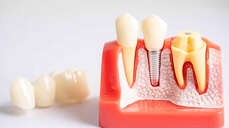 Why Implant Dentistry Requires Strong Bone Support
